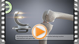 medizinische animation oxford_schlittenprothese